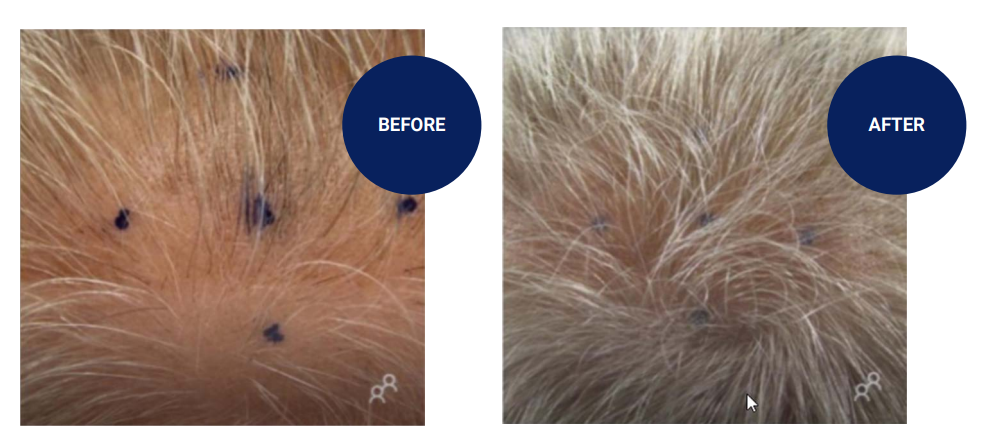 Androgenic Alopecia reversal