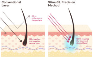 A conventional laser showing 15% of light penetrating skin vs. the StimuSIL method, with 100% of light reaching the target